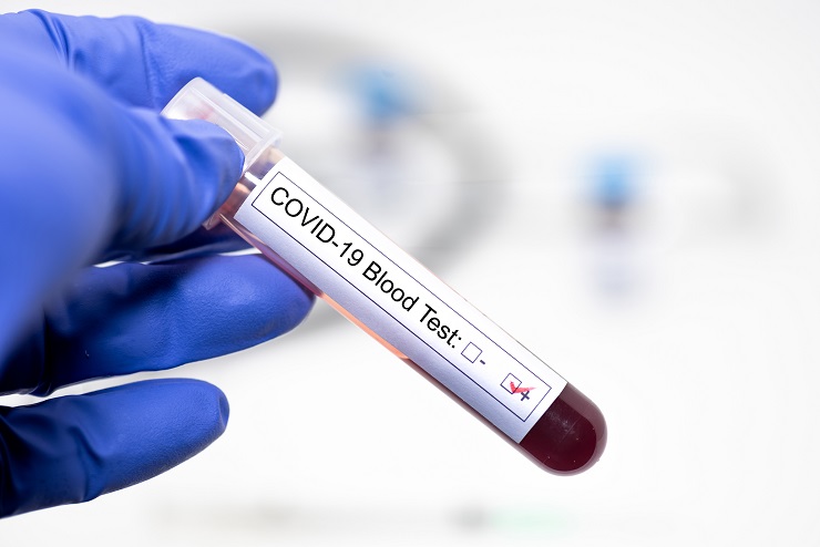 COVID-19 coronavirus positive blood sample diagnosed in hospital