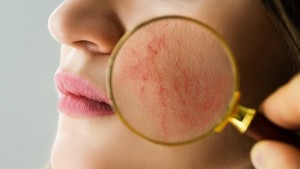 rosácea-proteger-tu-piel-durante-el-invierno